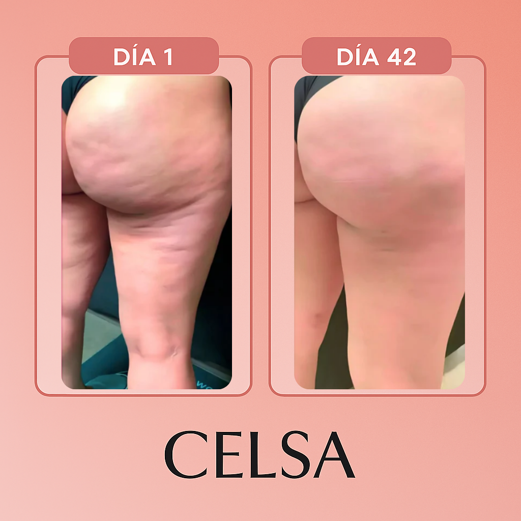 Celsa - Masajeador Anticelulítico